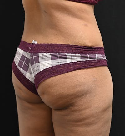Female Liposuction Before & After Gallery - Patient 301386 - Image 10