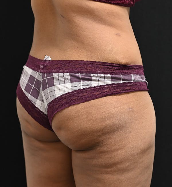 Female Liposuction Before & After Gallery - Patient 301386 - Image 10