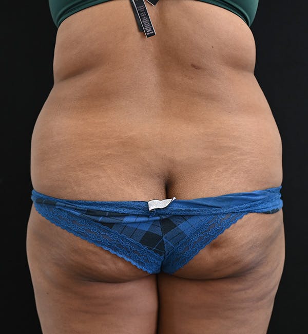 Female Liposuction Before & After Gallery - Patient 301386 - Image 11