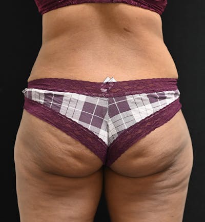 Female Liposuction Before & After Gallery - Patient 301386 - Image 12