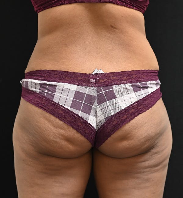 Female Liposuction Before & After Gallery - Patient 301386 - Image 12