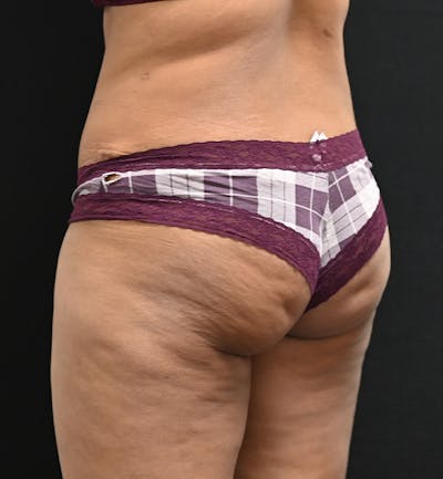 Female Liposuction Before & After Gallery - Patient 301386 - Image 14