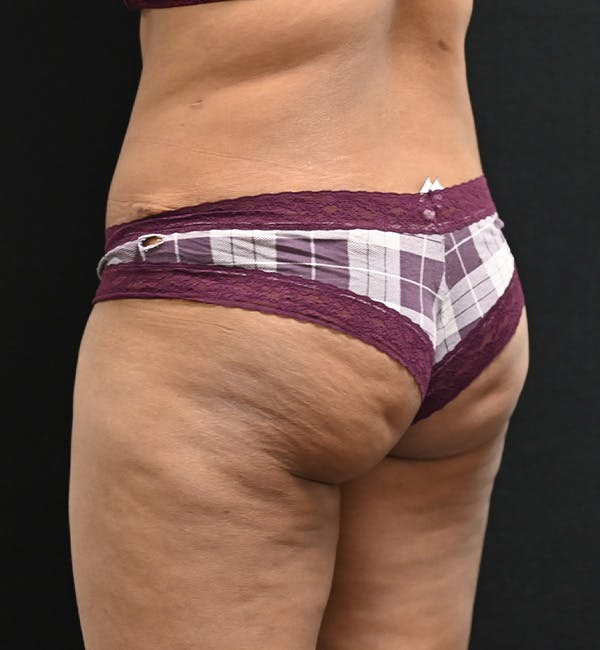 Female Liposuction Before & After Gallery - Patient 301386 - Image 14