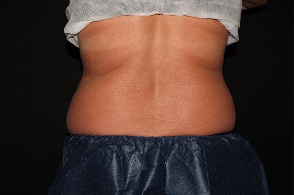 CoolSculpting® Elite Before & After Gallery - Patient 392307 - Image 11