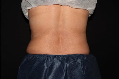 CoolSculpting® Elite Before & After Gallery - Patient 392307 - Image 12