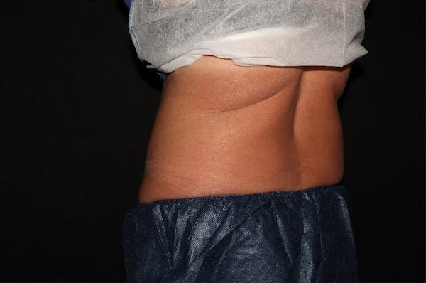 CoolSculpting® Elite Before & After Gallery - Patient 392307 - Image 9