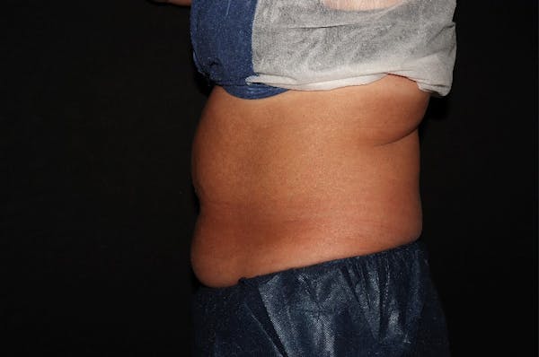 CoolSculpting® Elite Before & After Gallery - Patient 392307 - Image 7