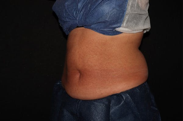 CoolSculpting® Elite Before & After Gallery - Patient 392307 - Image 5
