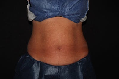 CoolSculpting® Elite Before & After Gallery - Patient 392307 - Image 1