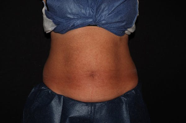 CoolSculpting® Elite Before & After Gallery - Patient 392307 - Image 1