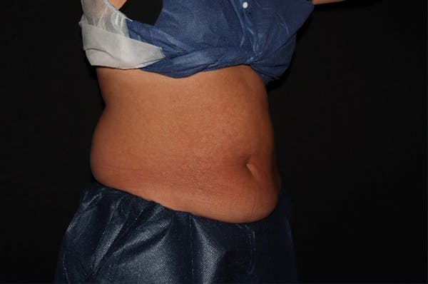 CoolSculpting® Elite Before & After Gallery - Patient 392307 - Image 3