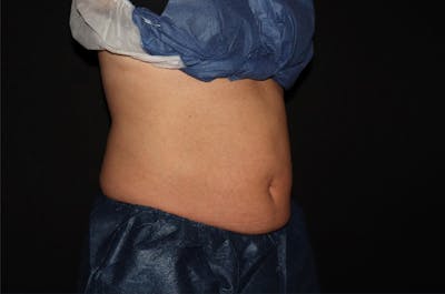 CoolSculpting® Elite Before & After Gallery - Patient 392307 - Image 4