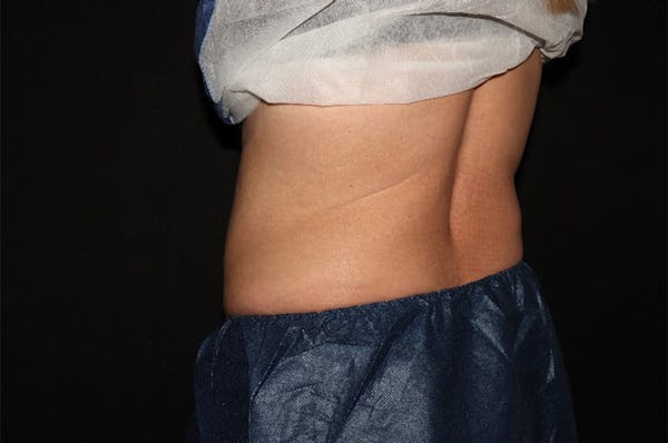CoolSculpting® Elite Before & After Gallery - Patient 392307 - Image 10