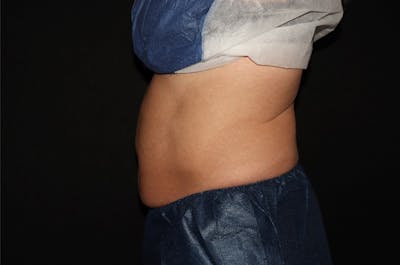 CoolSculpting® Elite Before & After Gallery - Patient 392307 - Image 8