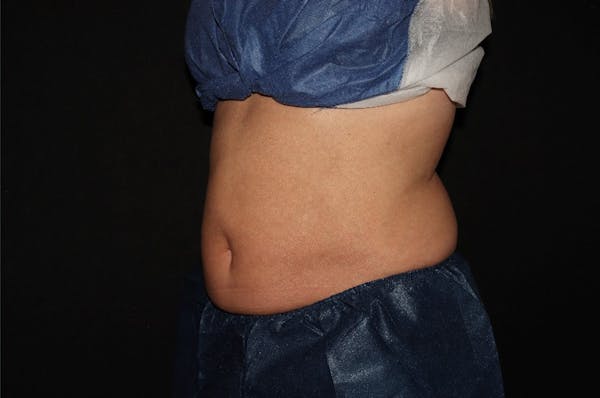 CoolSculpting® Elite Before & After Gallery - Patient 392307 - Image 6