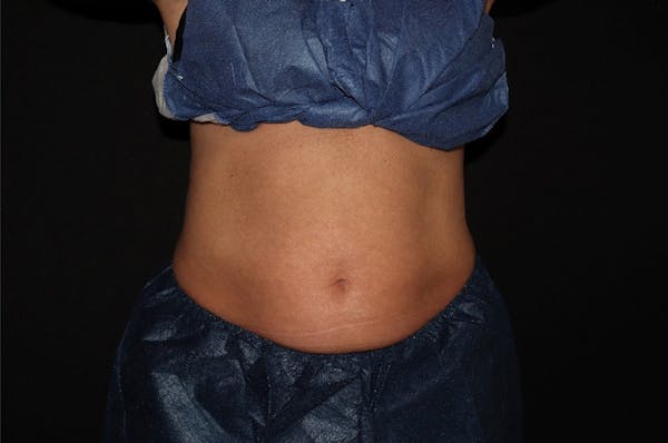 CoolSculpting® Elite Before & After Gallery - Patient 392307 - Image 2