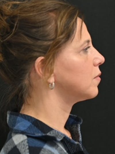 Facelift Before & After Gallery - Patient 282423 - Image 4