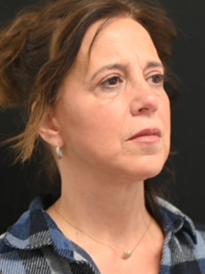 Facelift Before & After Gallery - Patient 282423 - Image 2