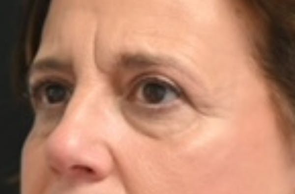 Eye Lift Before & After Gallery - Patient 159594 - Image 4