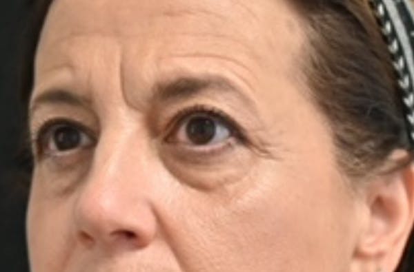 Eye Lift Before & After Gallery - Patient 159594 - Image 3