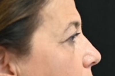 Eye Lift Before & After Gallery - Patient 159594 - Image 1