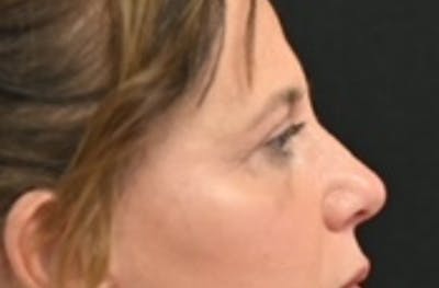 Eye Lift Before & After Gallery - Patient 159594 - Image 2