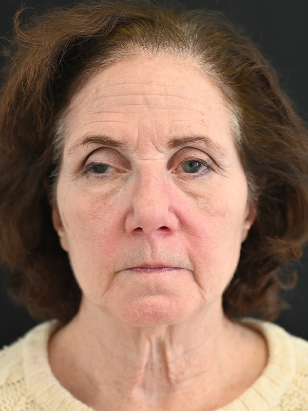 Facelift Before & After Gallery - Patient 317269 - Image 1