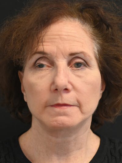 Facelift Before & After Gallery - Patient 317269 - Image 2