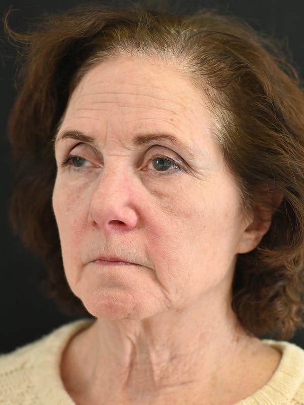 Facelift Before & After Gallery - Patient 317269 - Image 3