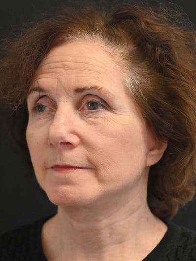 Facelift Before & After Gallery - Patient 317269 - Image 4