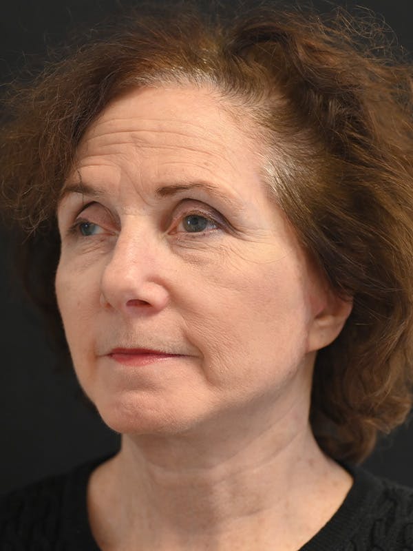 Facelift Before & After Gallery - Patient 317269 - Image 4