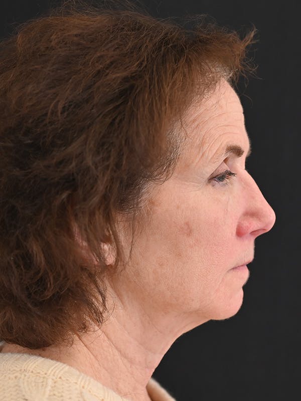 Facelift Before & After Gallery - Patient 317269 - Image 5