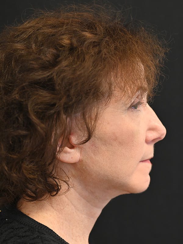 Facelift Before & After Gallery - Patient 317269 - Image 6