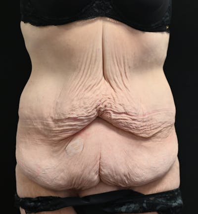 Tummy Tuck Before & After Gallery - Patient 151094 - Image 1