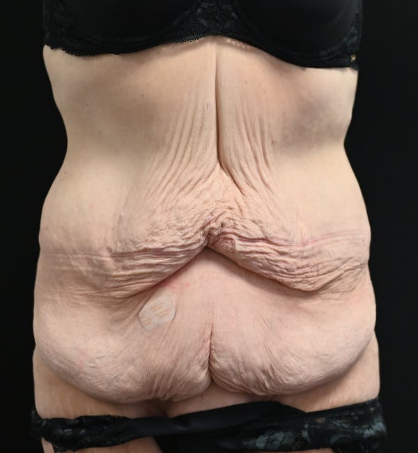 Tummy Tuck Before & After Gallery - Patient 151094 - Image 1