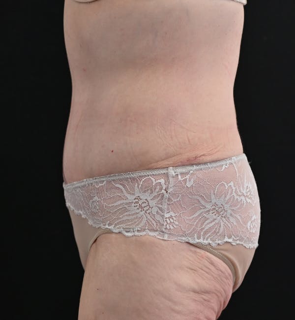 Tummy Tuck Before & After Gallery - Patient 151094 - Image 10