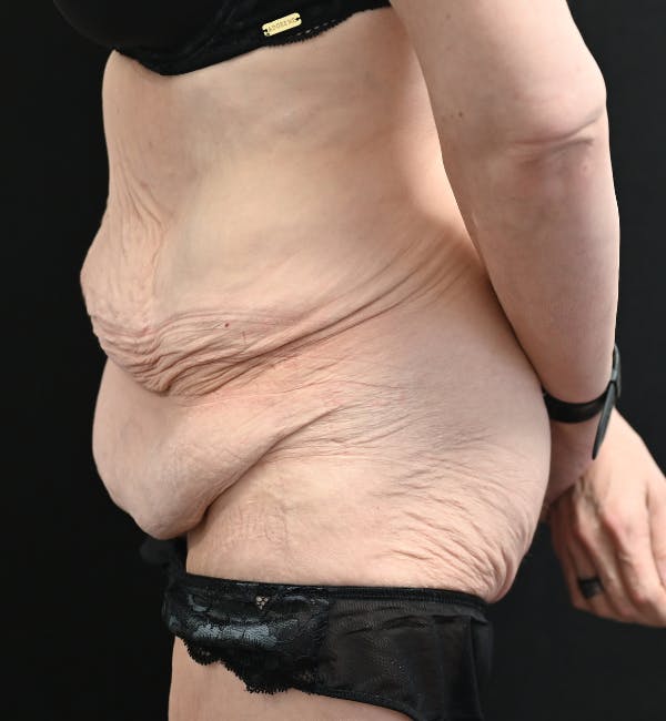 Tummy Tuck Before & After Gallery - Patient 151094 - Image 9