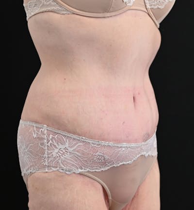 Tummy Tuck Before & After Gallery - Patient 151094 - Image 4