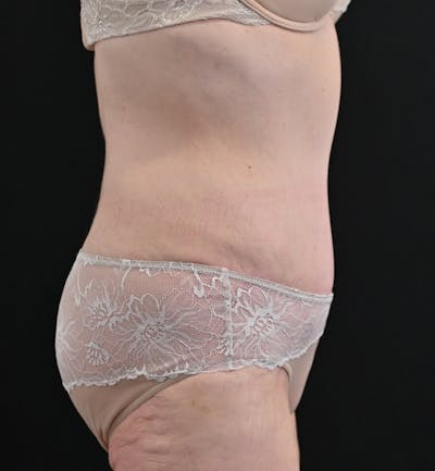 Tummy Tuck Before & After Gallery - Patient 151094 - Image 6