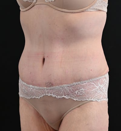 Tummy Tuck Before & After Gallery - Patient 151094 - Image 8