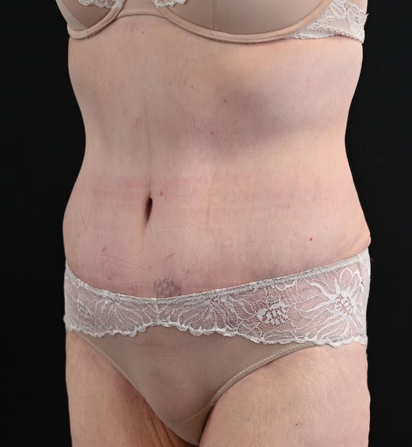 Tummy Tuck Before & After Gallery - Patient 151094 - Image 8