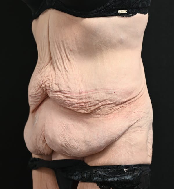 Tummy Tuck Before & After Gallery - Patient 151094 - Image 7