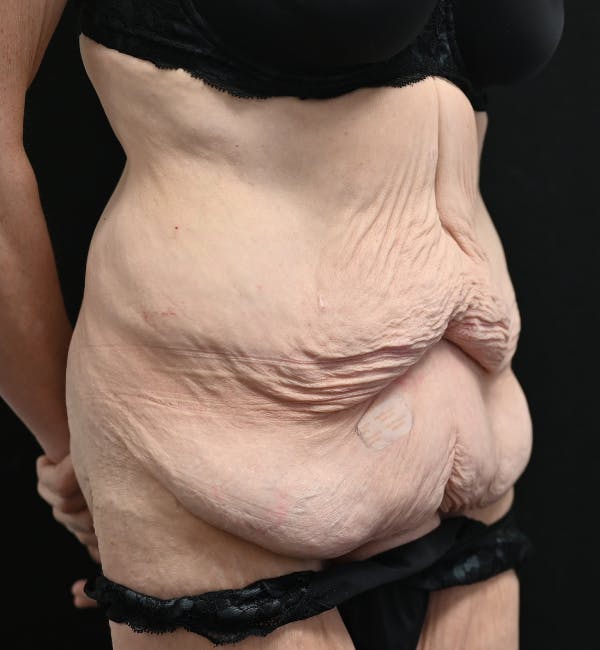 Tummy Tuck Before & After Gallery - Patient 151094 - Image 3