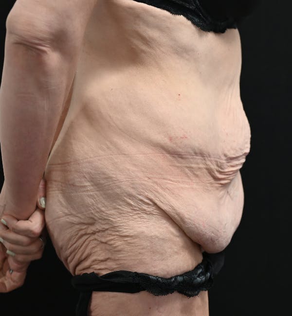 Tummy Tuck Before & After Gallery - Patient 151094 - Image 5