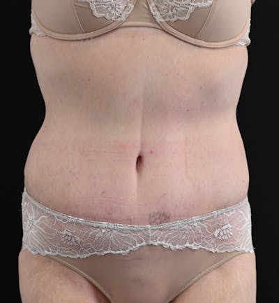 Tummy Tuck Before & After Gallery - Patient 151094 - Image 2