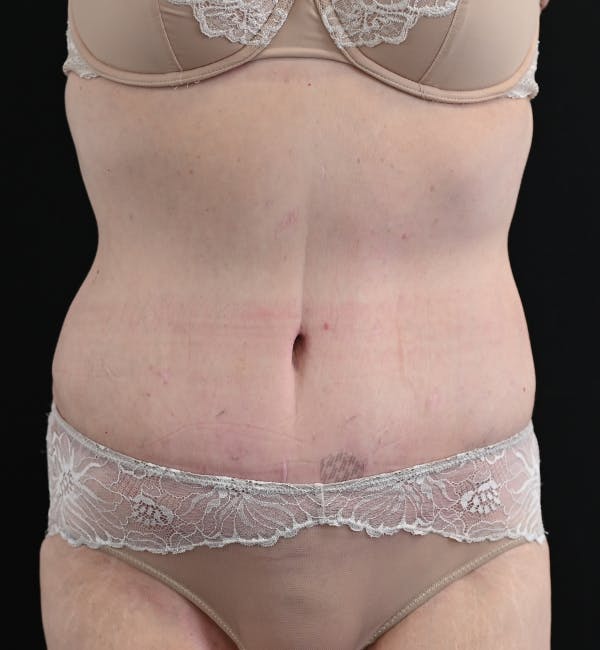 Tummy Tuck Before & After Gallery - Patient 151094 - Image 2