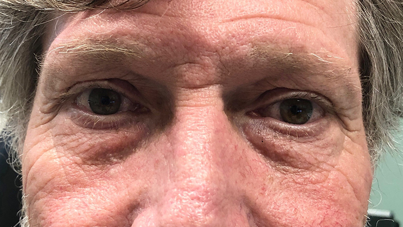 Eyelid Surgery Before & After Gallery - Patient 32619504 - Image 1