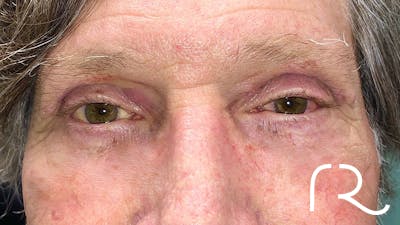 Eyelid Surgery Before & After Gallery - Patient 32619504 - Image 2