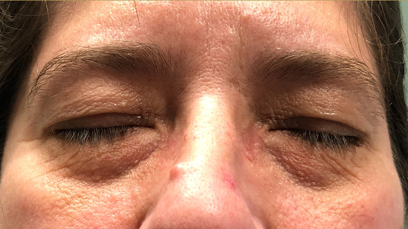 Eyelid Surgery Before & After Gallery - Patient 32619505 - Image 1