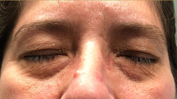 Eyelid Surgery Results